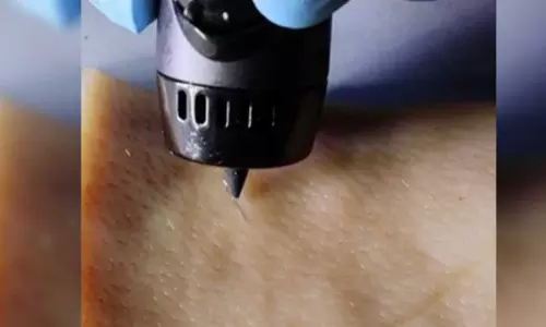 New wound-healing ink repairs cuts with a 3D-printing pen