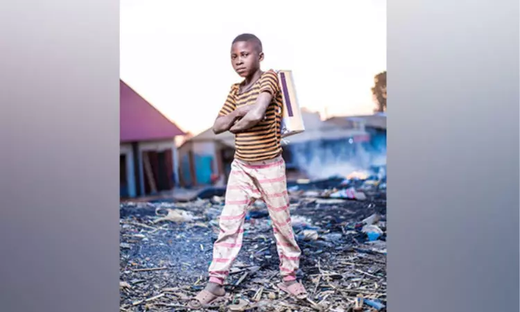 Children who live close to busy roads are more likely to get atopic dermatitis: Study