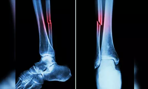 Covid can cause bone loss, higher fracture risk: Study