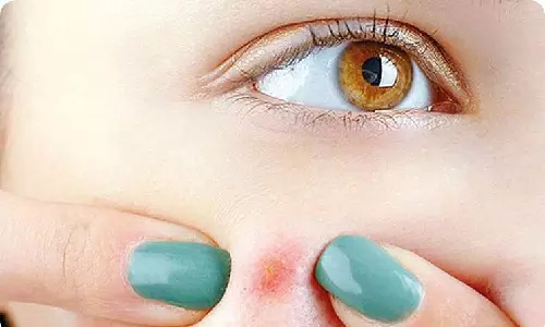 Experts clear myths surrounding pimples