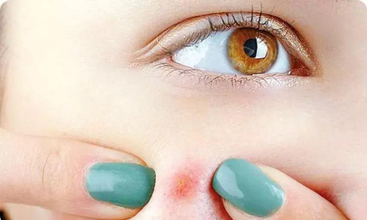 Experts clear myths surrounding pimples