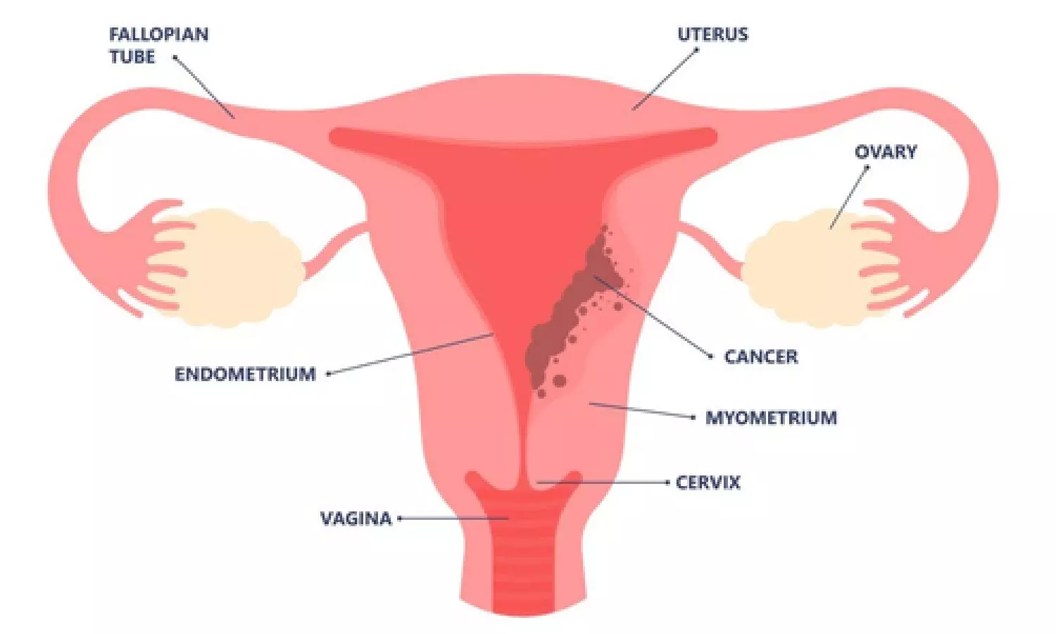 Testosterone shows promise to treat endometrial cancer: Study