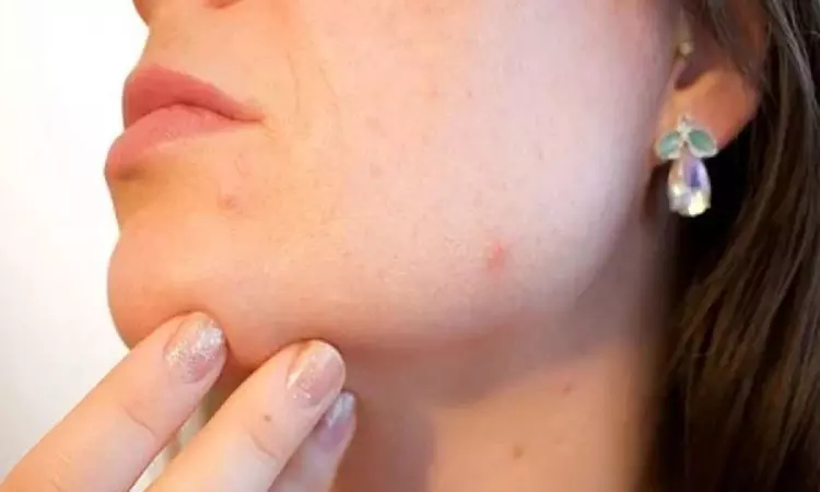 Acne bacteria trigger cells to produce fats, oils and other lipids essential to skin health