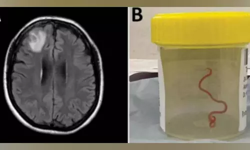 8-cm live worm removed from womans brain in worlds 1st discovery