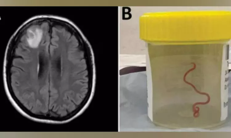 8-cm live worm removed from womans brain in worlds 1st discovery