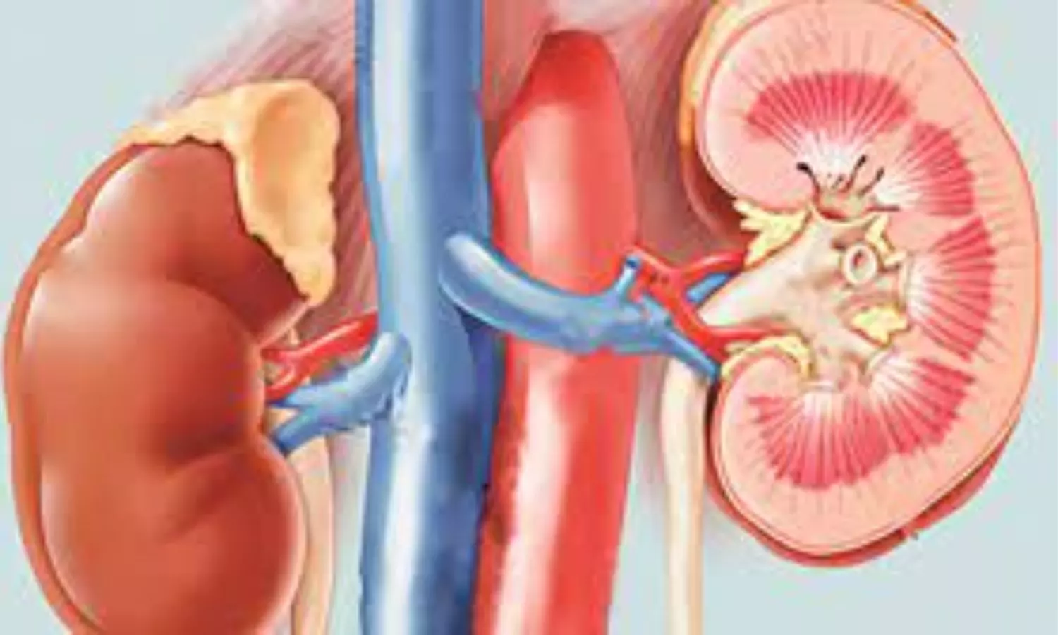 New artificial kidney-like device to free patients from dialysis