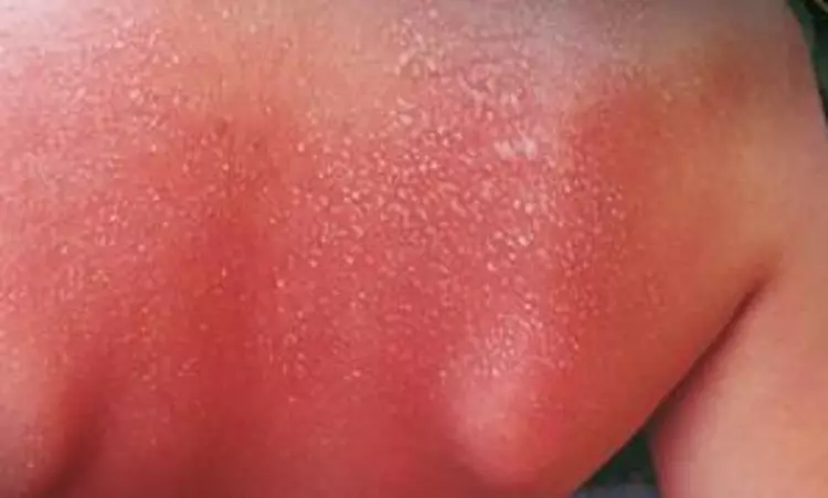 New super melanin cream to heal your skin from chemical, sunburn