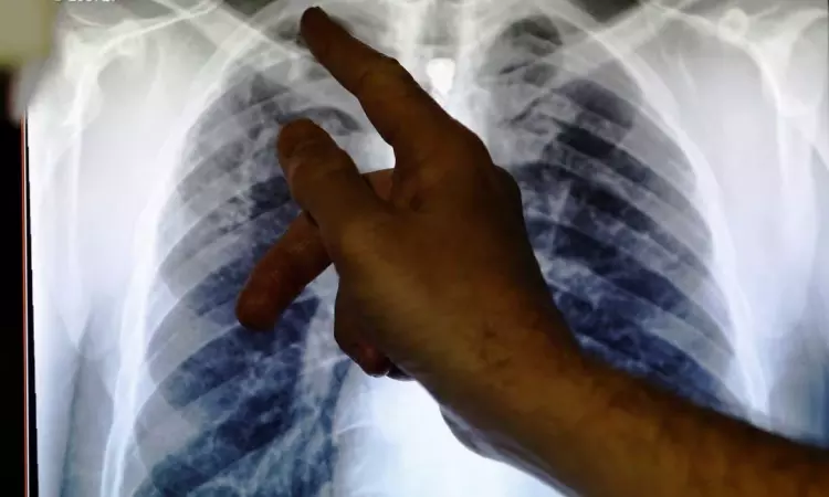 Record 7.5 mn people globally diagnosed with TB in 2022: WHO