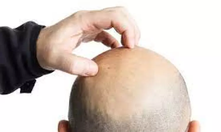 Hair transplant biz set to treble to $560 mn by 2032