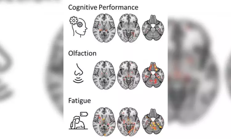 New MRI study reveals how brain changes in long-Covid patients