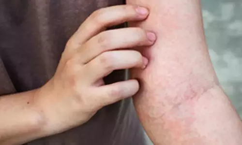 Study finds common microbe that causes persistent itching