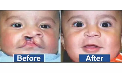 Two-day camp to conduct free plastic surgery for cleft lip