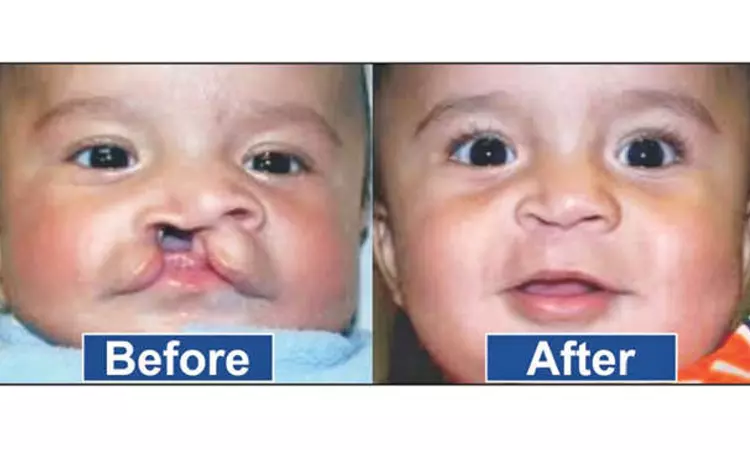 Two-day camp to conduct free plastic surgery for cleft lip