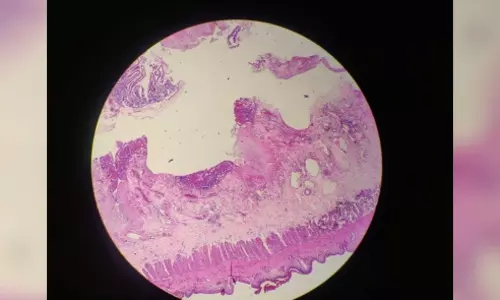 Global fungal disease deaths doubled in a decade: Study