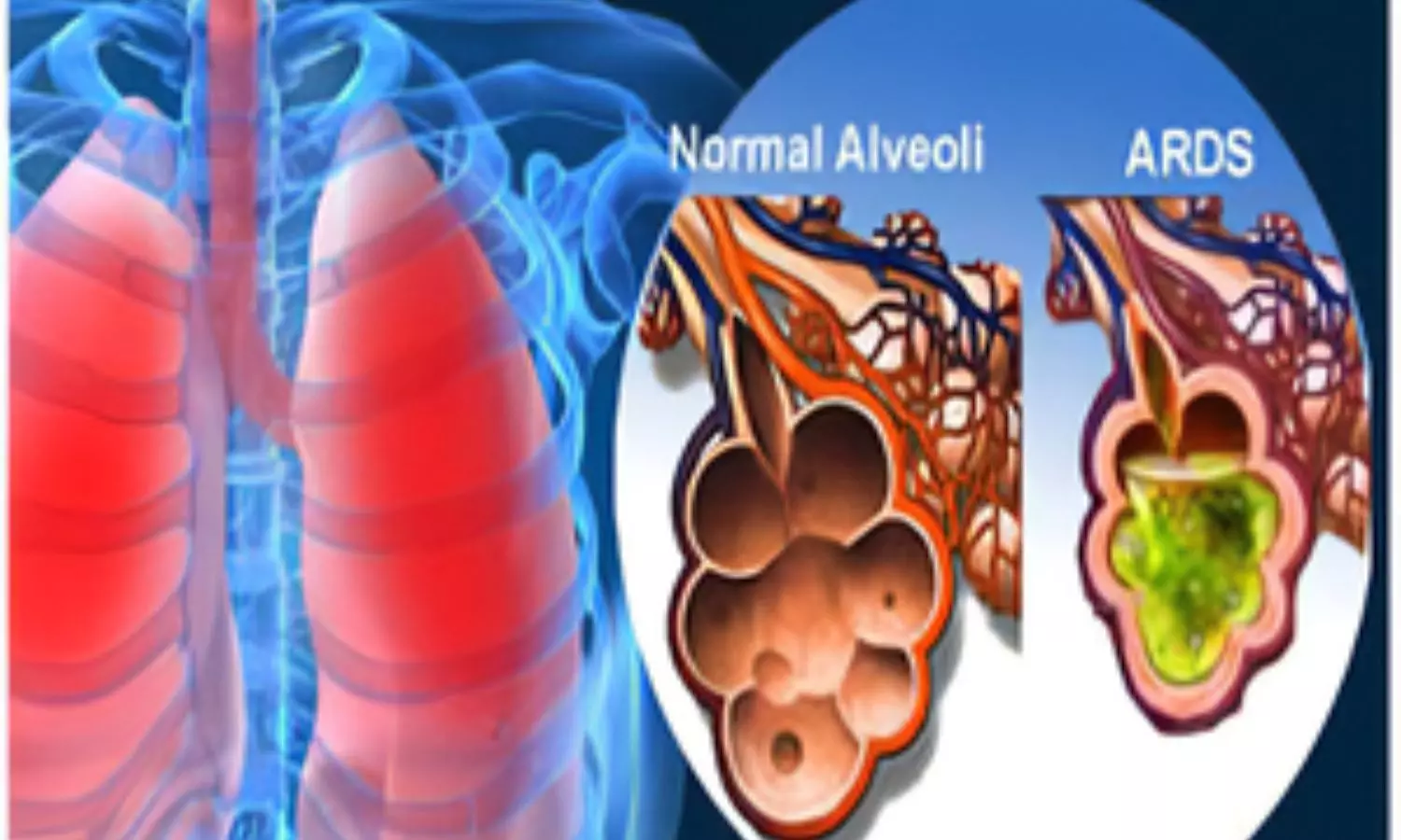 New cell therapy shows promise for Covid-related respiratory distress