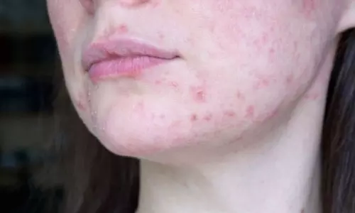 AI may automate diagnosis of lupus nephritis: Report