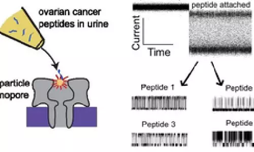 New method may detect early ovarian cancer from urine test