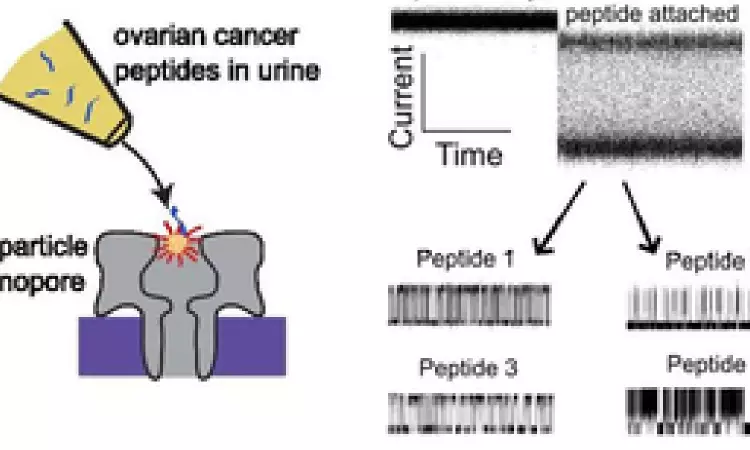 New method may detect early ovarian cancer from urine test