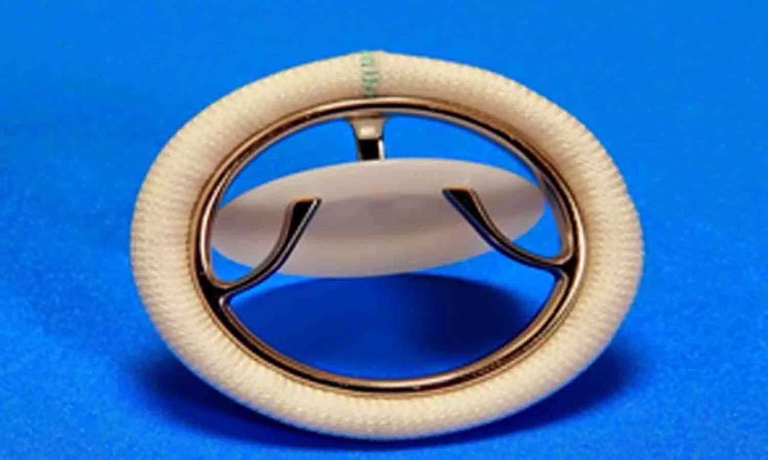 Upgraded Chitra heart valve implanted in 40 patients in pilot project