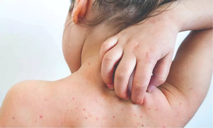 Measles and Mumps cases see a slight surge, doctors advice to stay cautious