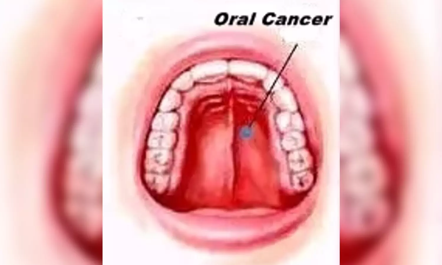 Why India is seeing a rise in oral cancer cases