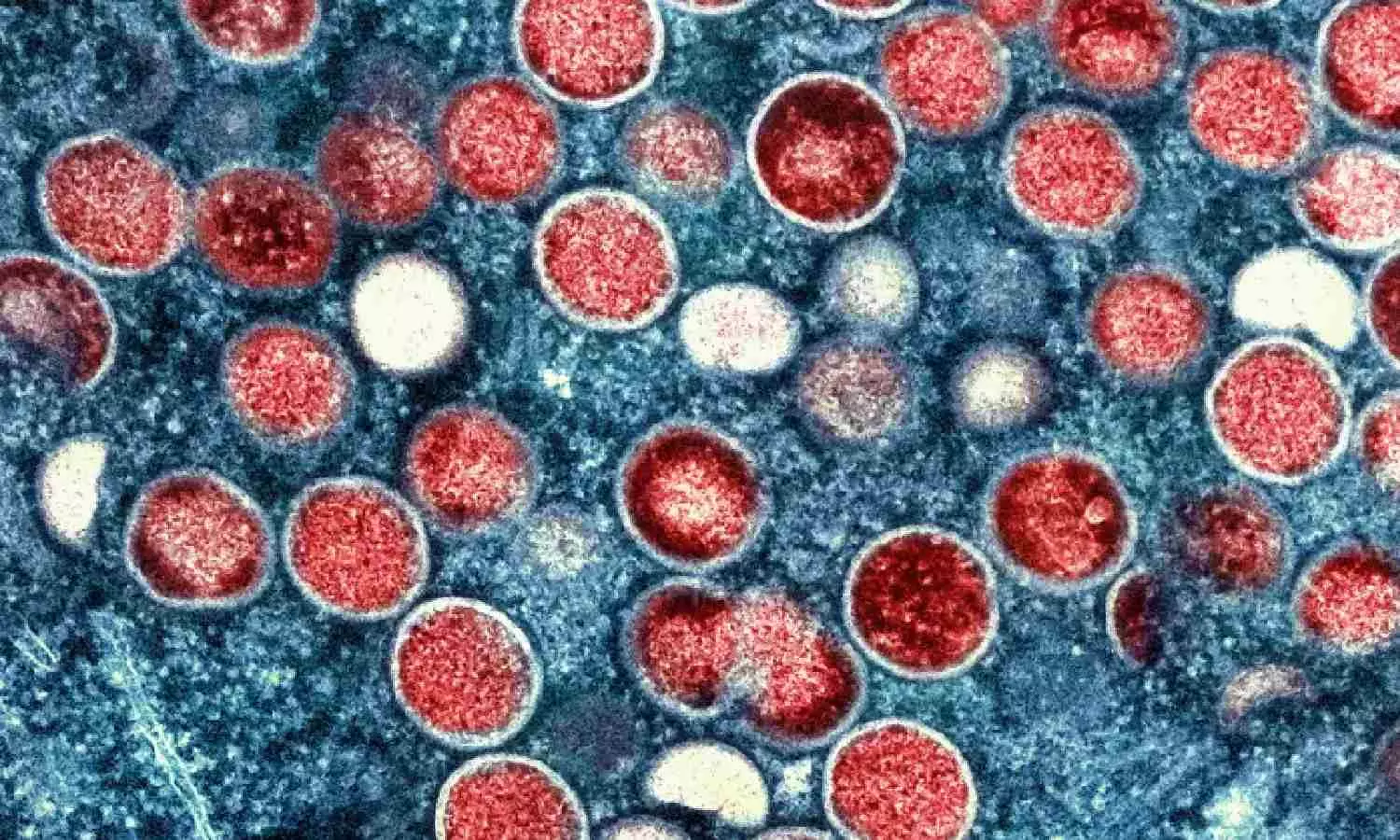 A new form of mpox that may spread more easily found in Congos biggest outbreak