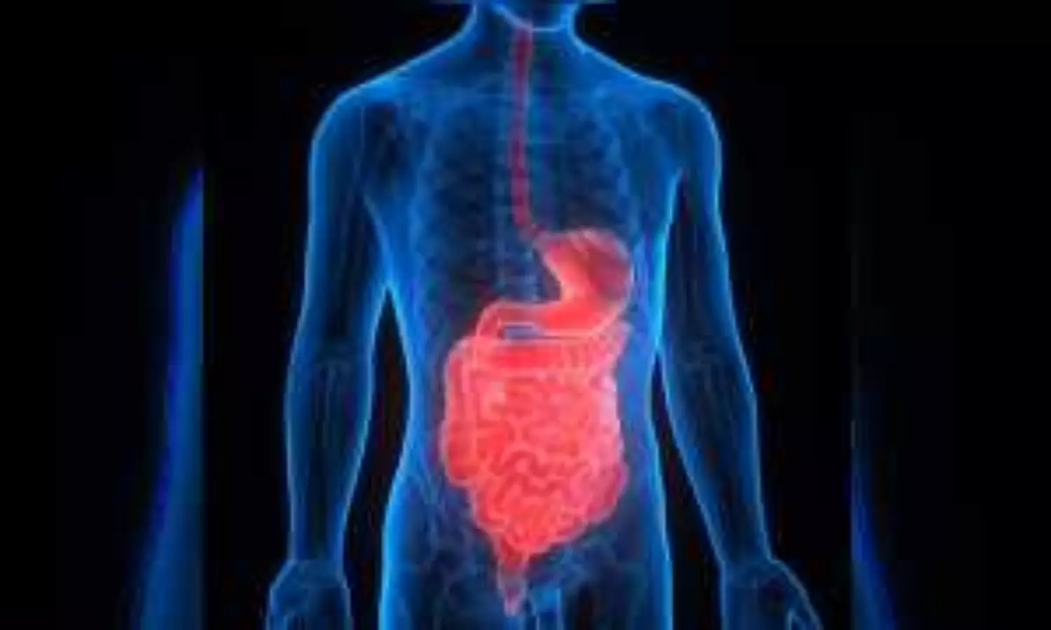 What is Inflammatory bowel disease? Why is it rising in India?
