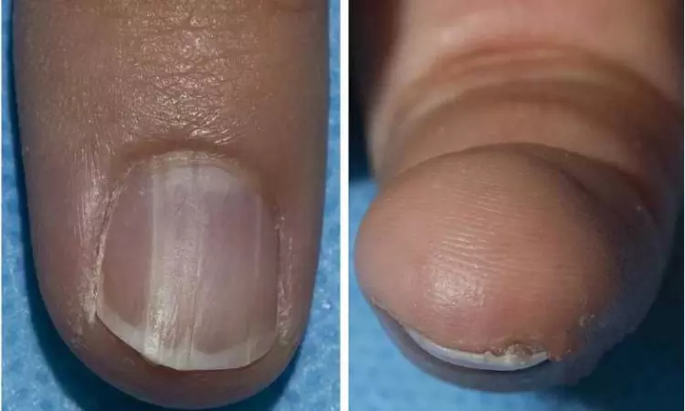 How your nail colour can signal cancer risk How your nail colour can signal cancer risk