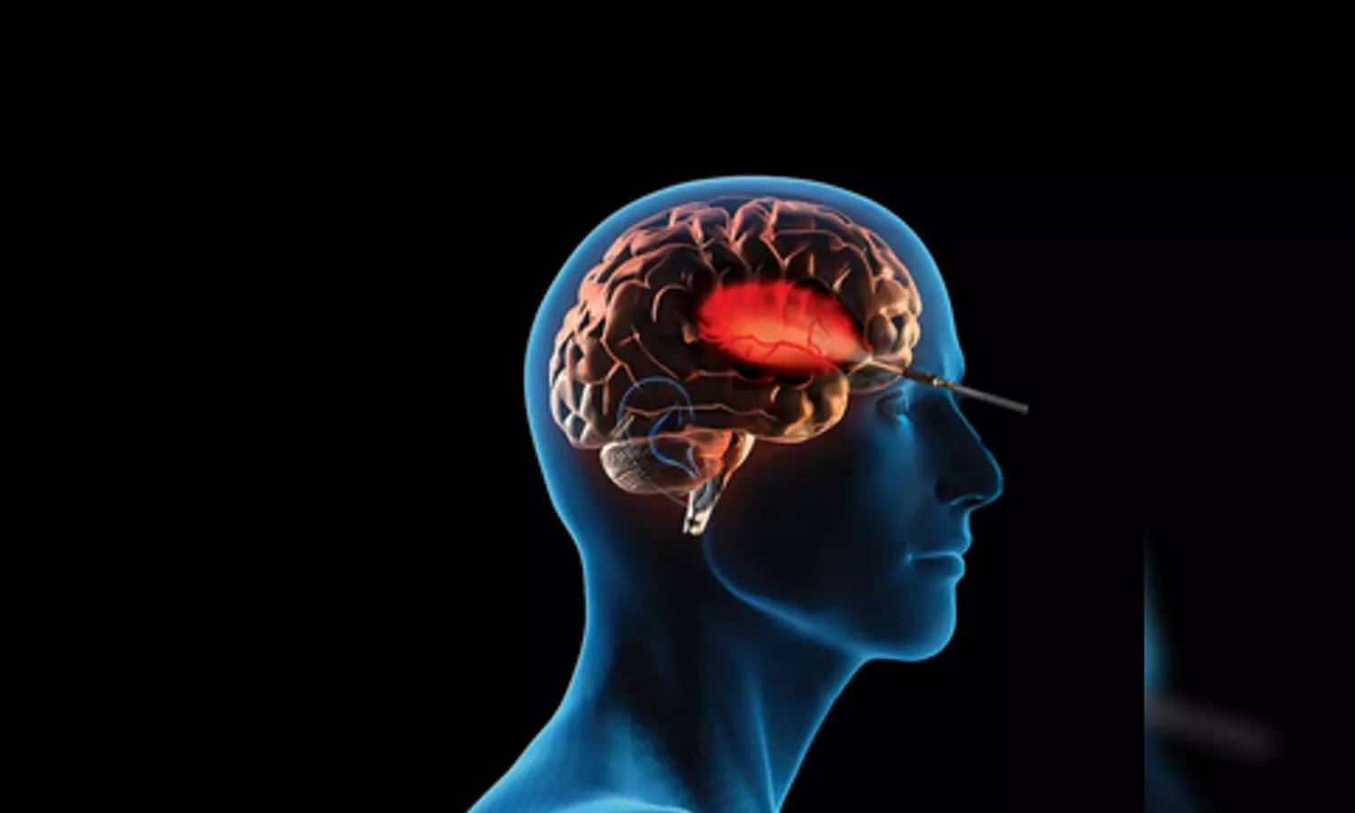 Chennai docs ace world-1st keyhole surgery for insular brain tumour via eyebrow