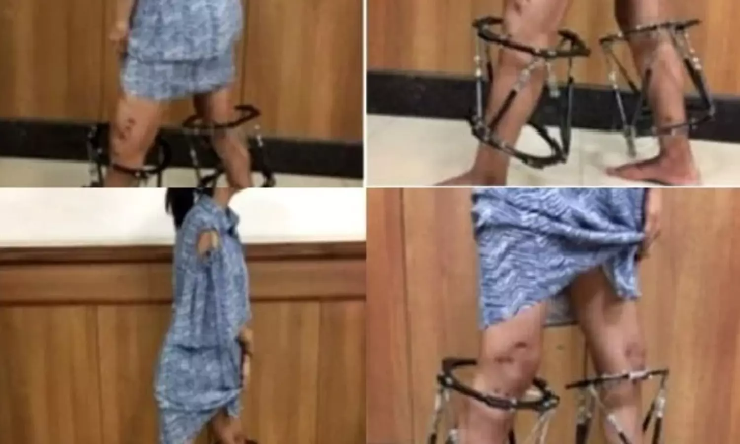 New AI-assisted technique makes teenage girls crooked legs straight