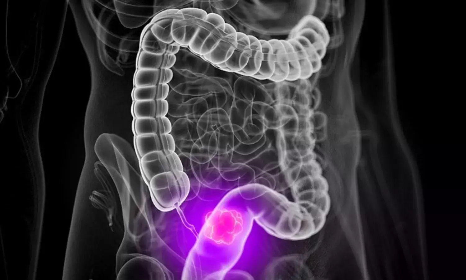 Rise in colorectal cancer among teens a serious issue