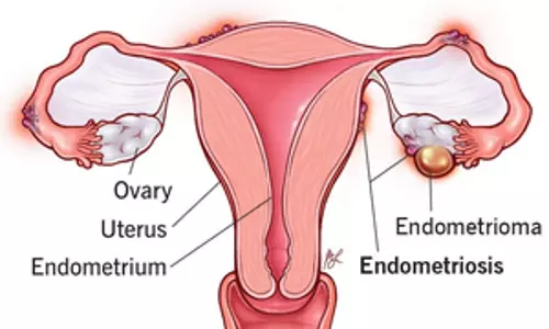 Swiss researchers develop a hydrogel implant to treat endometriosis
