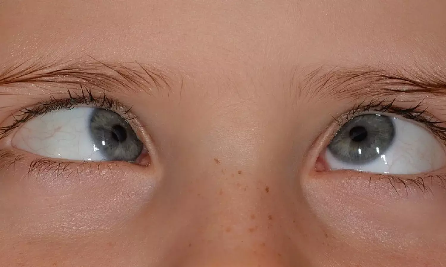 Refractive error main reason behind squinting