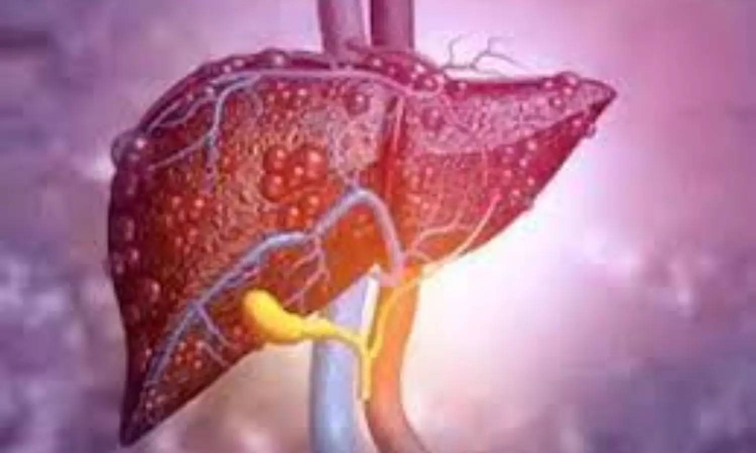 Study shows poor sleep may worsen fatty liver disease