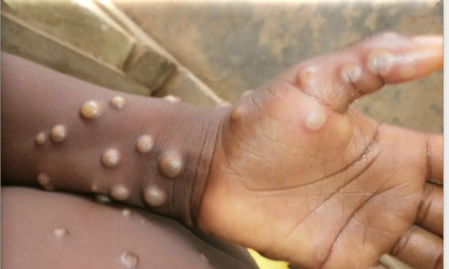 Death toll from monkeypox in Africa nears 1,000 as cases exceed 38,000