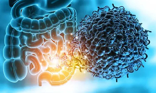 Study shows how gut microbiome raises risk of multiple sclerosis