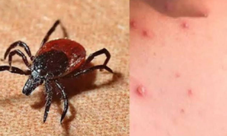 Rural communities at high risk of scrub typhus infections: Study