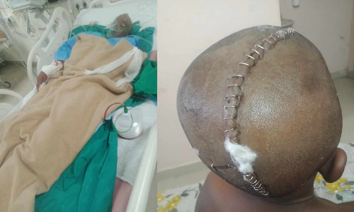 Tamil Naduu: PE teacher brutally assaults Class 6 Dalit student leaving him with fractured skull