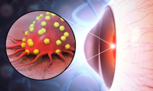 Study shows new drug delivery system effective against rare eye cancer