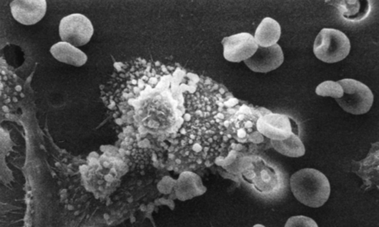 New method turns tumour-supporting cells into killers New method turns tumour-supporting cells into killers