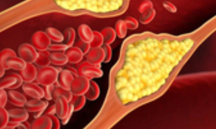 Indian scientists develop optical sensing platform to detect cholesterol