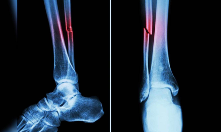 New machine algorithm can identify heart, fracture risks with routine bone scans New machine algorithm can identify heart, fracture risks with routine bone scans