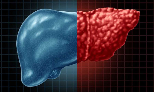 Diabetes drug can effectively treat fatty liver: Study