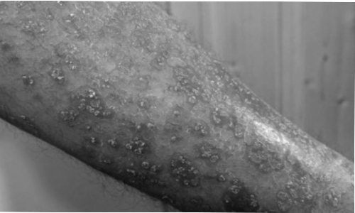 Skin cancer surges worldwide in older men in last 30 years: Study