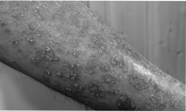 Skin cancer surges worldwide in older men in last 30 years: Study Skin cancer surges worldwide in older men in last 30 years: Study