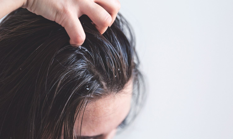 The itchy truth: Dandruff, a lifelong recurring concern The itchy truth: Dandruff, a lifelong recurring concern