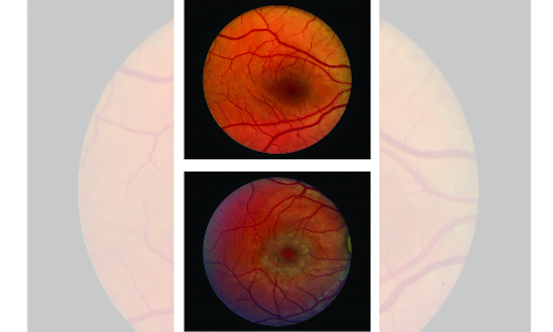 Surgical implant can slow down vision loss caused by blinding eye disease: Study