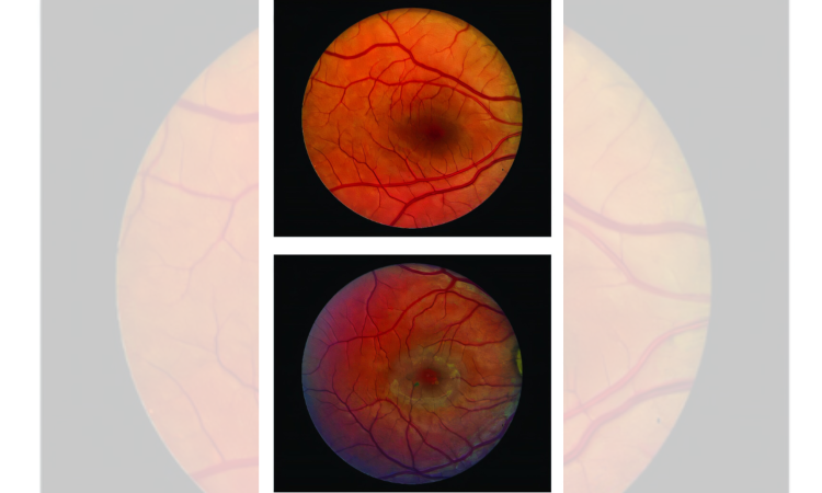 Surgical implant can slow down vision loss caused by blinding eye disease: Study