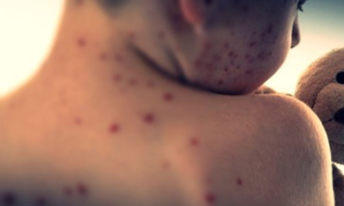 Israel reports 152 new measles cases, total at 770