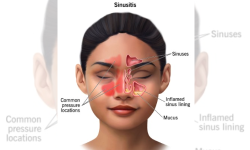 Surgery more effective in treating chronic sinus than antibiotics: Study